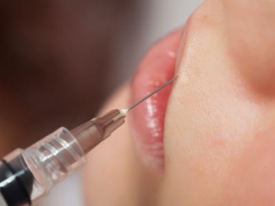 AcidoHialuronico_aumentolabios AcidoHialuronico_aumentolabios