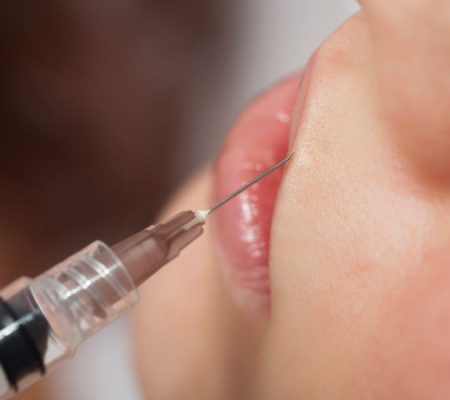AcidoHialuronico_aumentolabios AcidoHialuronico_aumentolabios