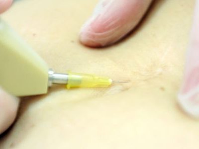 CARBOXITERAPIA CARBOXITERAPIA