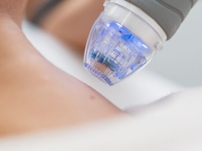 Dermapen_ClinicaLlado Dermapen_ClinicaLlado