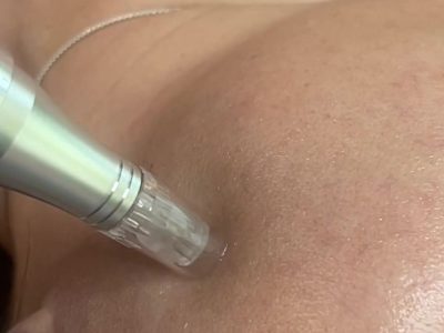 Dermapen_ClinicaLlado Dermapen_ClinicaLlado