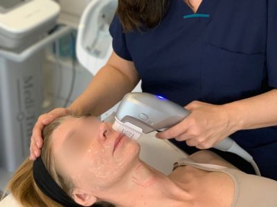 HifuFacial_ClinicaLlado HifuFacial_ClinicaLlado